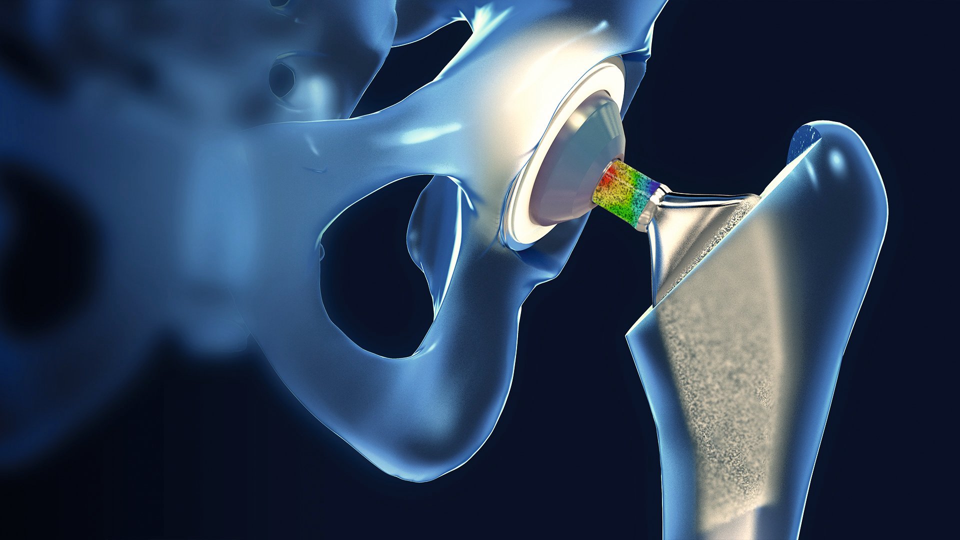 3D rendered hip implant with a strain colormap on the implant neck inside an acetabular cup.